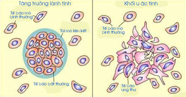 U lành tính - Hình ảnh minh họa